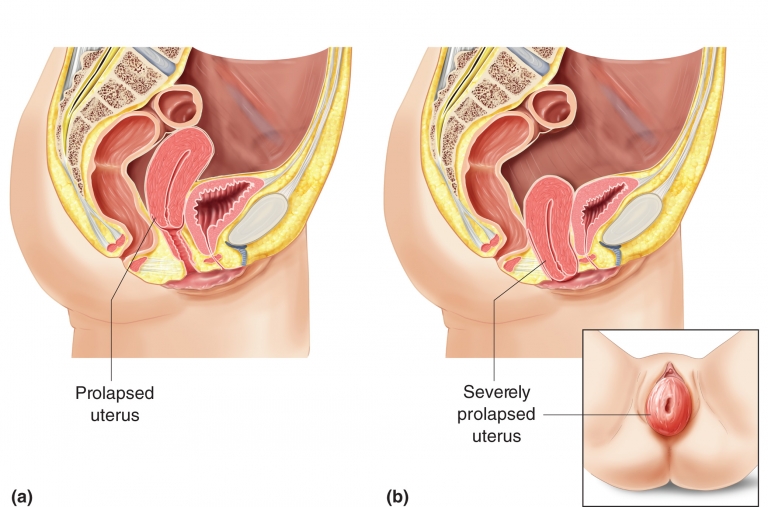 Vaginal Prolapse