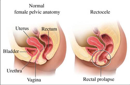 prolapse of rectum